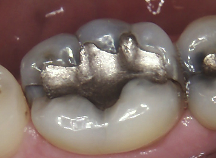 Intraoral Cameras
